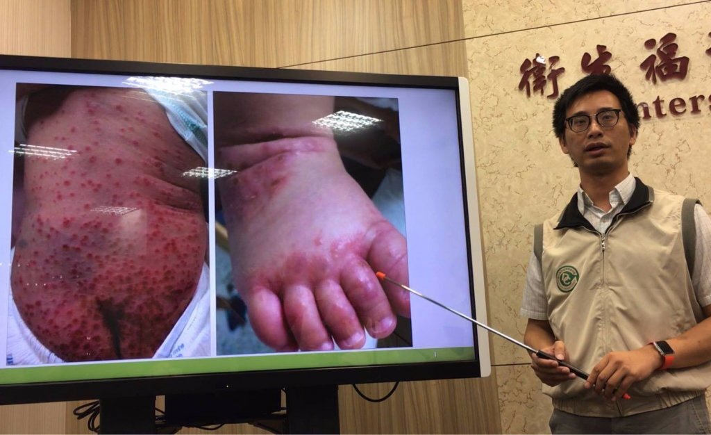 Taipei planche sur l'entérovirus et un entérovaccin