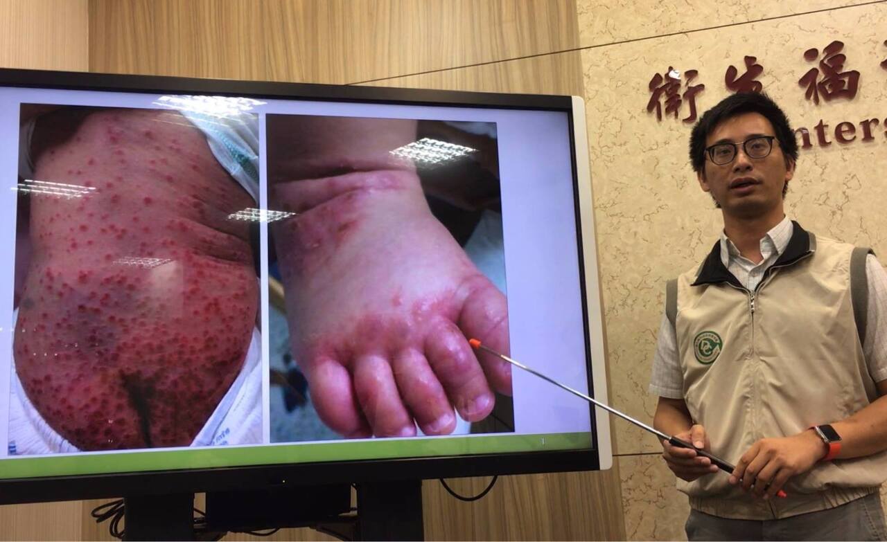 Taipei accueillera un forum international sur le diagnostic de l’entérovirus