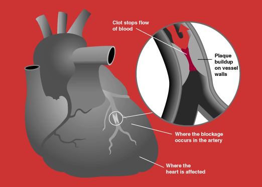L’insolation faciliterait l’infarctus du myocarde