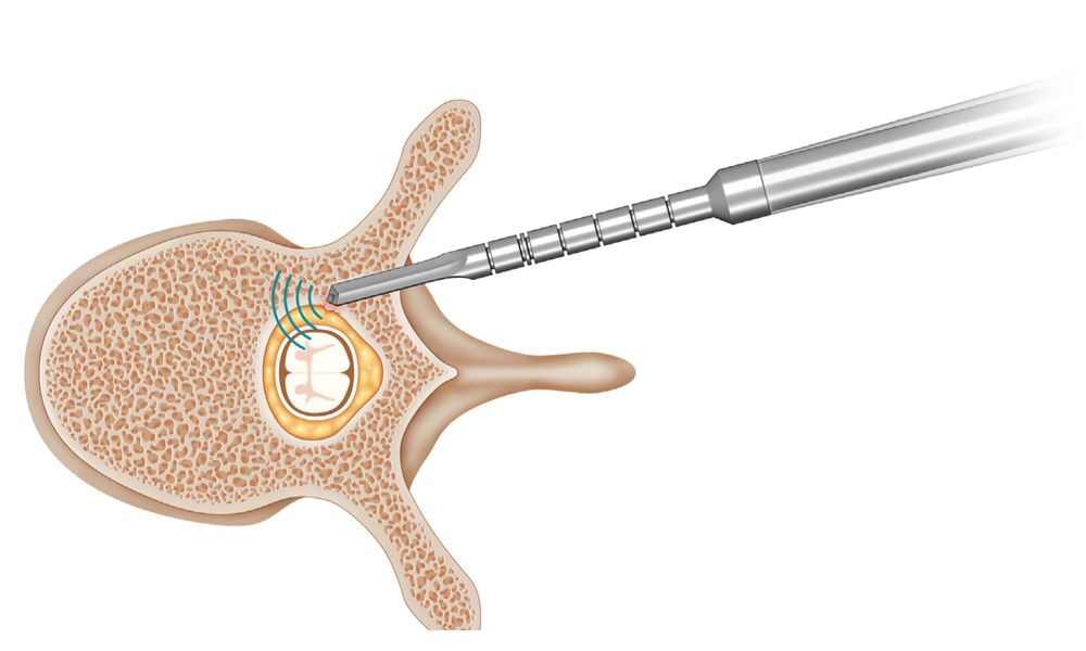 illustration des instruments de guidage de Spineguard (image site de la compagnie)