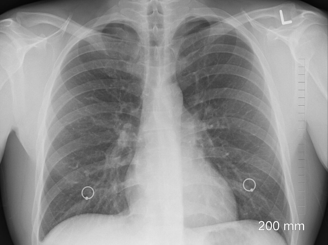 Infection pulmonaire non identifiée à Wuhan : Pékin évoque un nouveau coronavirus