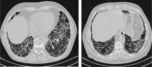 Vers des essais cliniques d’un traitement expérimental pour la fibrose pulmonaire