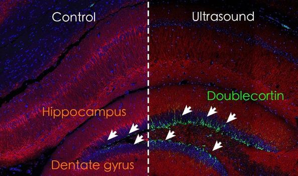 Vers un traitement non invasif par ultrasons pour soigner la démence vasculaire