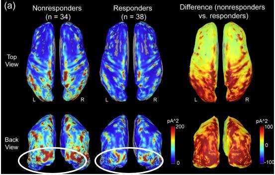 Percée scientifique : vers un traitement de précision de la migraine