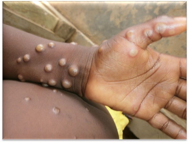 Variole du singe: Taïwan prévoit d’acheter des vaccins de 3e génération