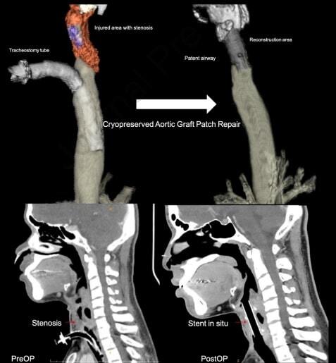 Première mondiale : une greffe d’artère permet la reconstruction d’une trachée