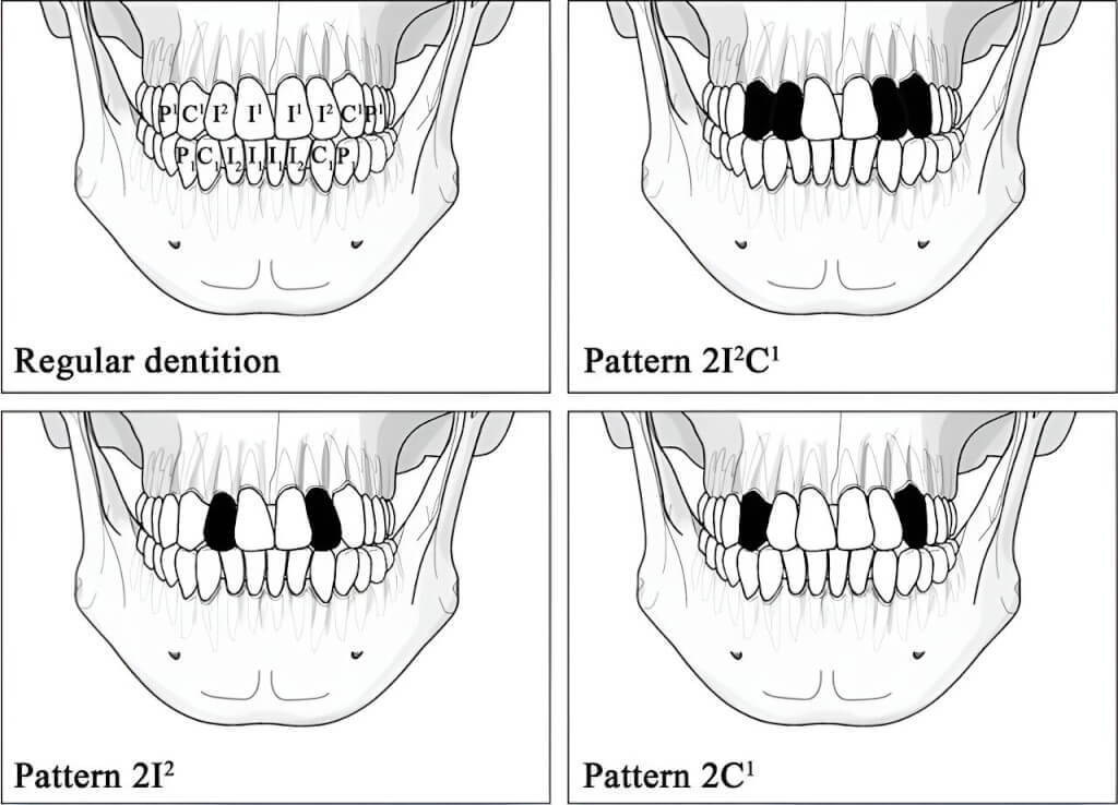 Il était une fois : les Taïwanais pratiquaient l’extraction dentaire rituelle